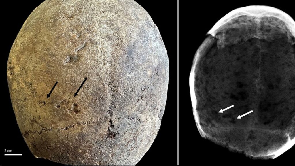 Top view of a skull (left) and an X-ray of the skull (right)