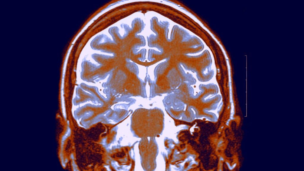 a structural scan of a brain shown through the skull and colored white and orange